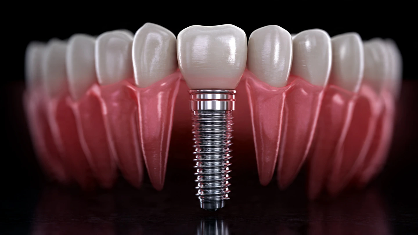Implant Case Study