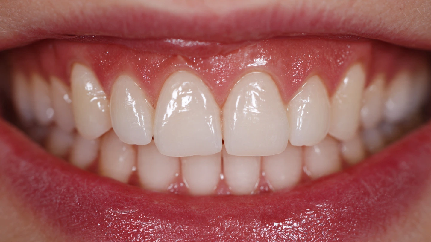 Braces Case Study