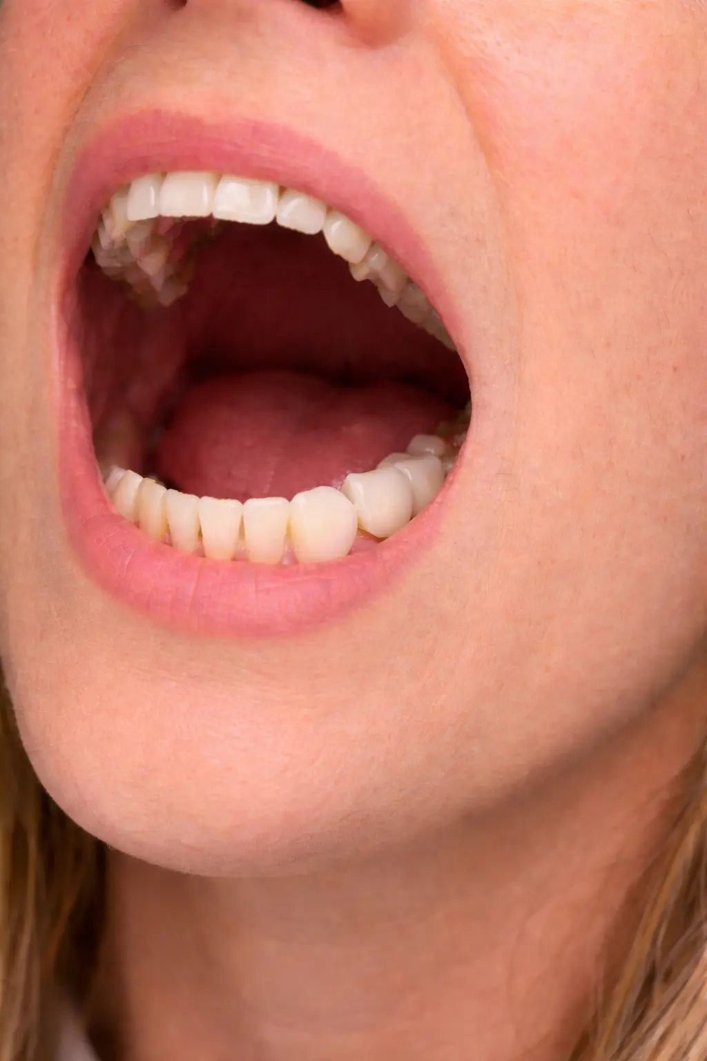 Integrated molar implant