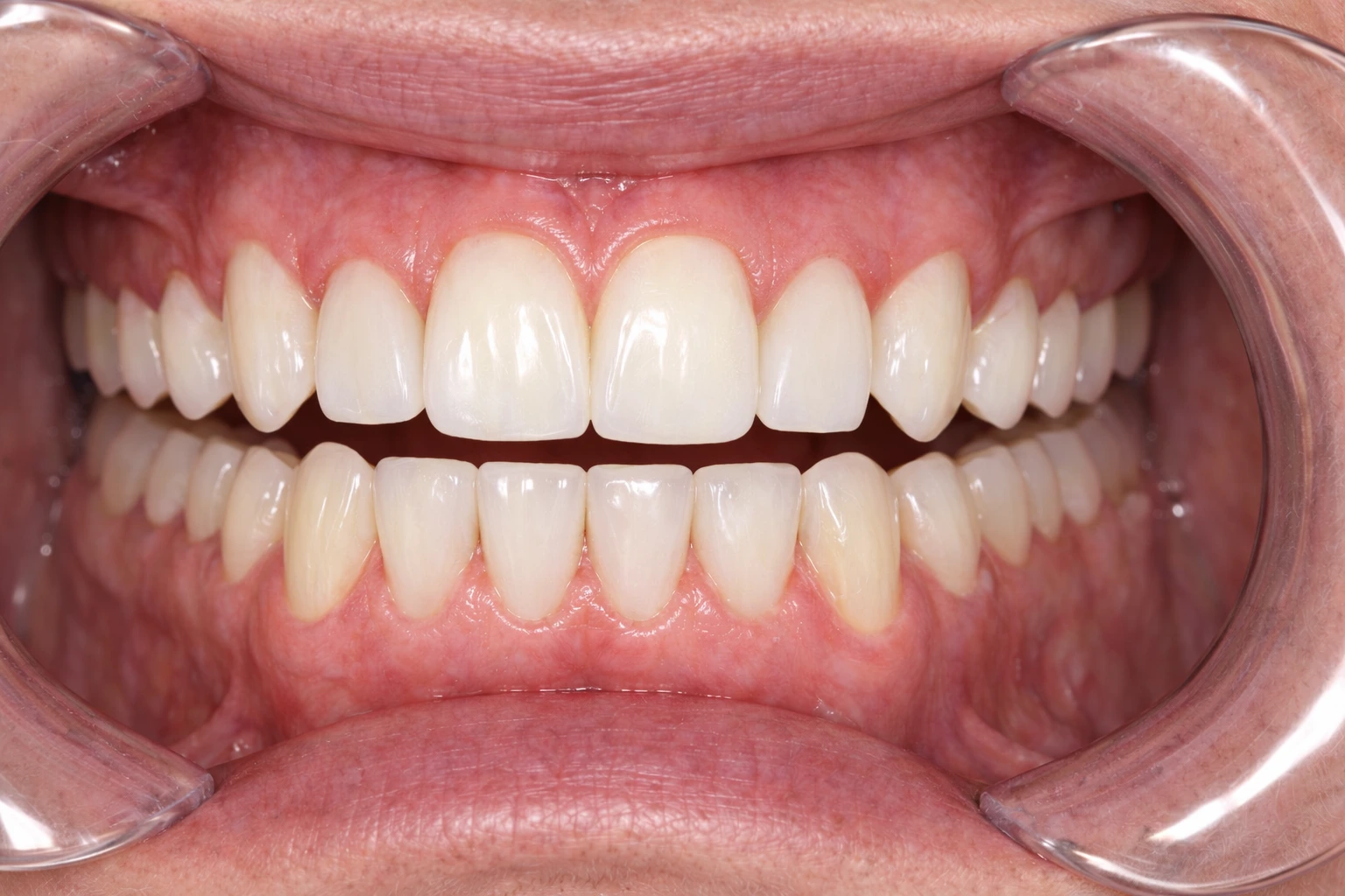 After Treatment