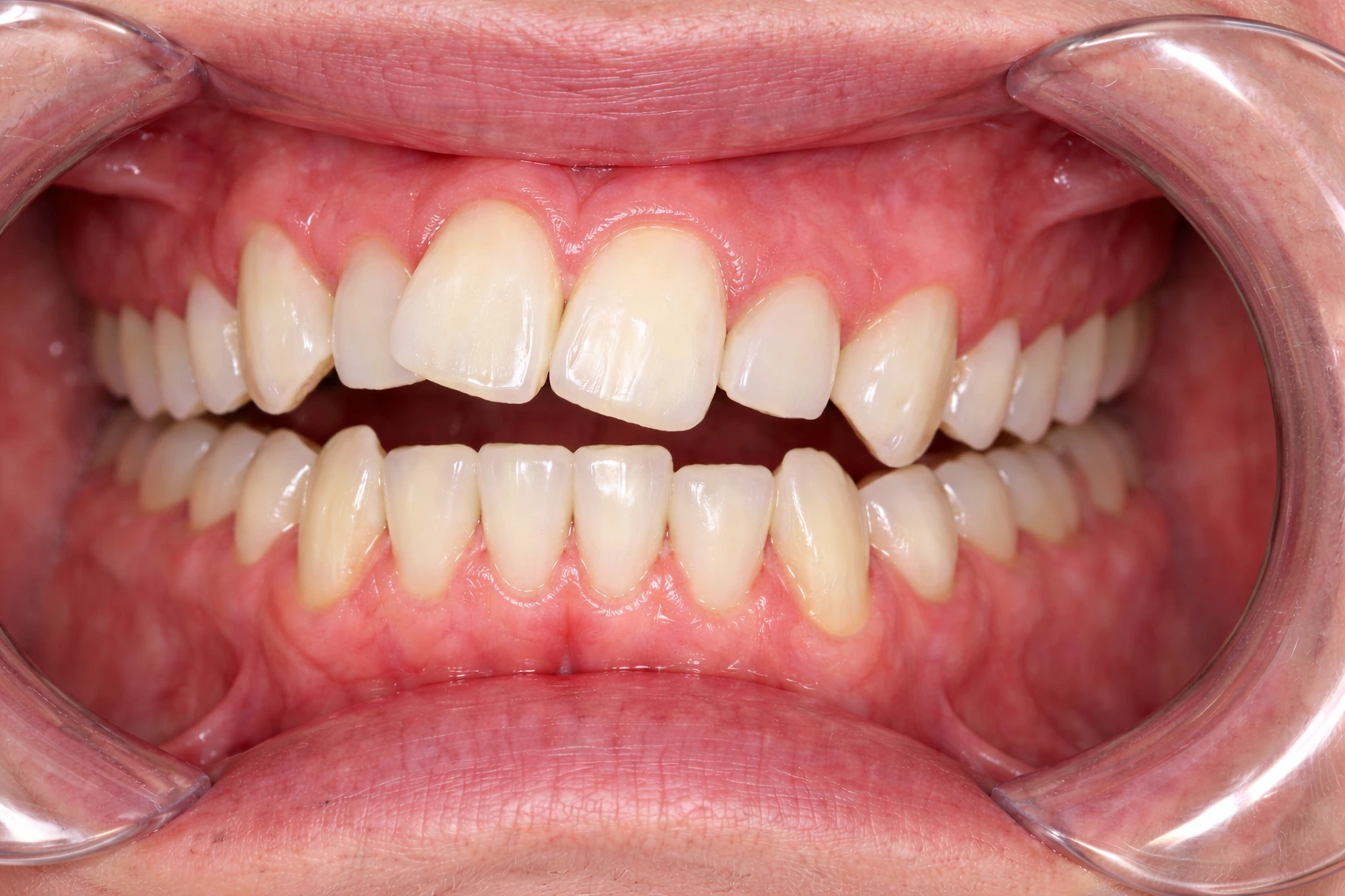 Before Treatment