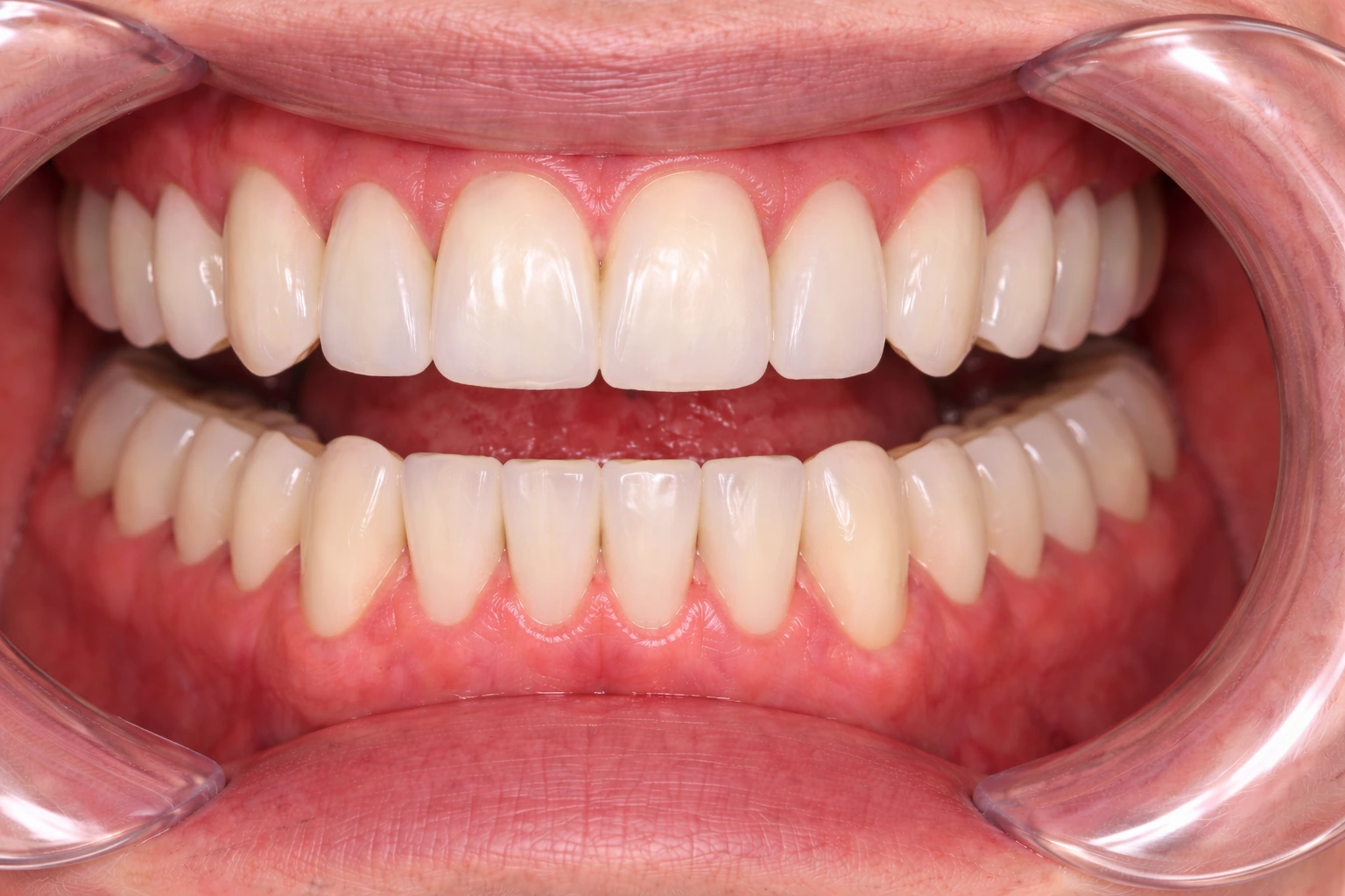 After Treatment