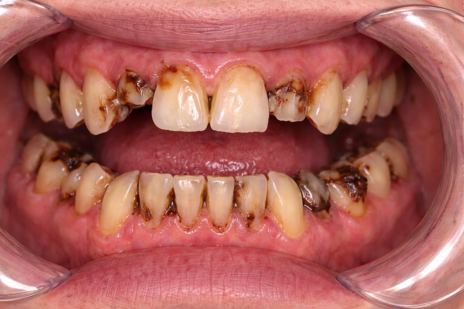 Before Treatment