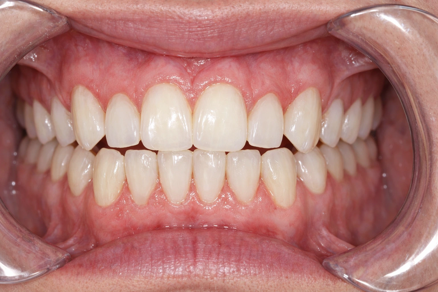 After Treatment