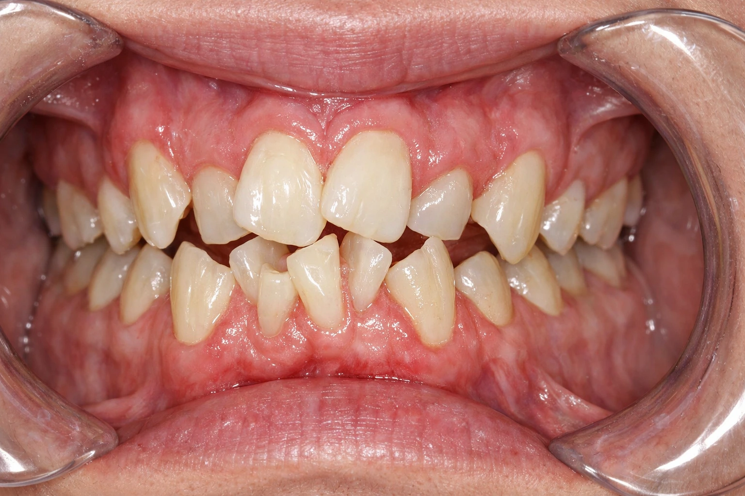 Before Treatment