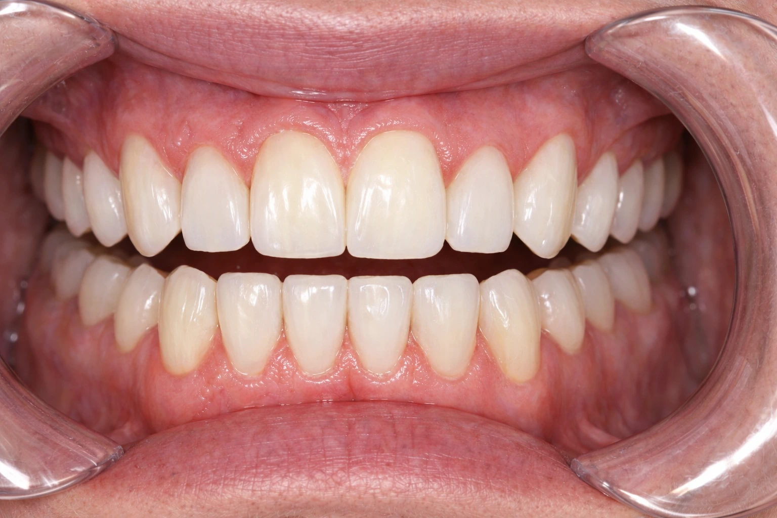 After Treatment