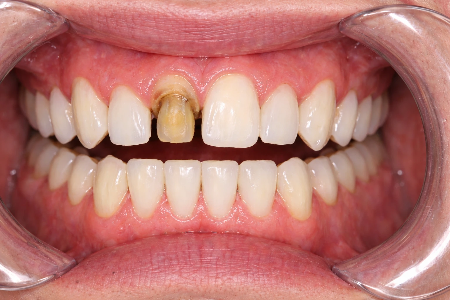 Before Treatment