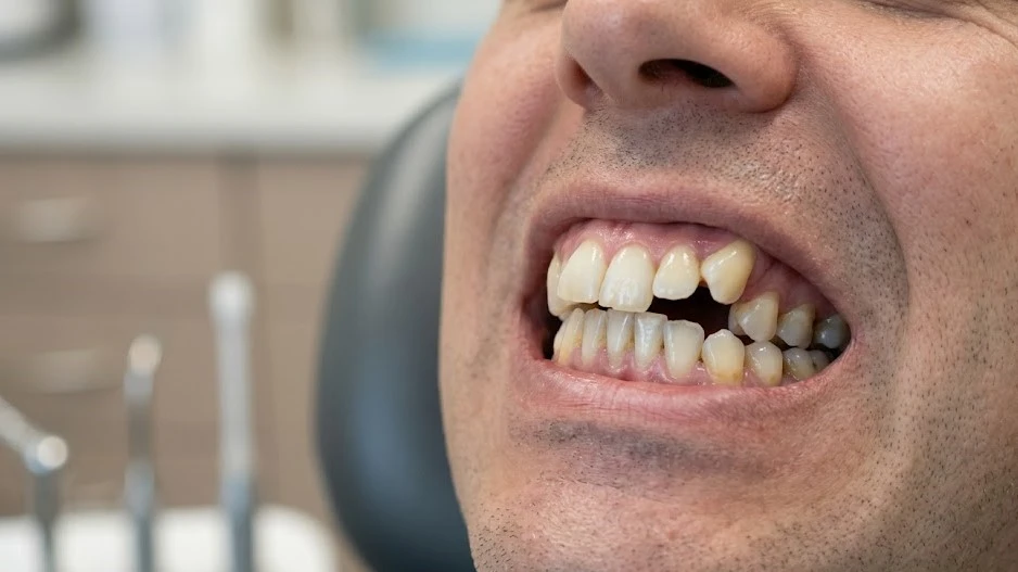 Aesthetic Braces